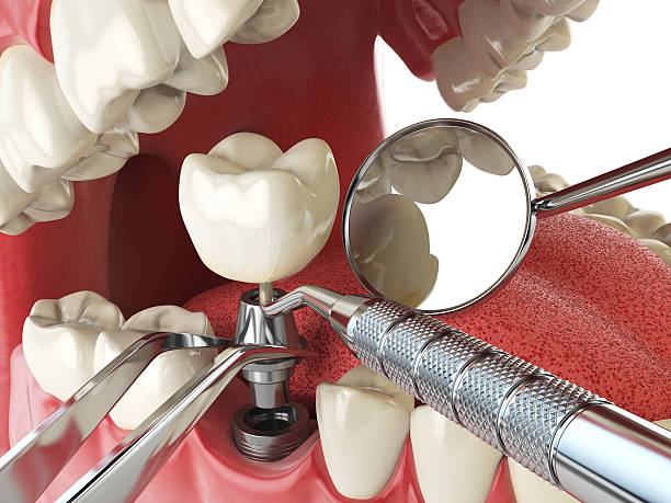 Best Lost Filling or Crown Replacement in Aspinwall, PA